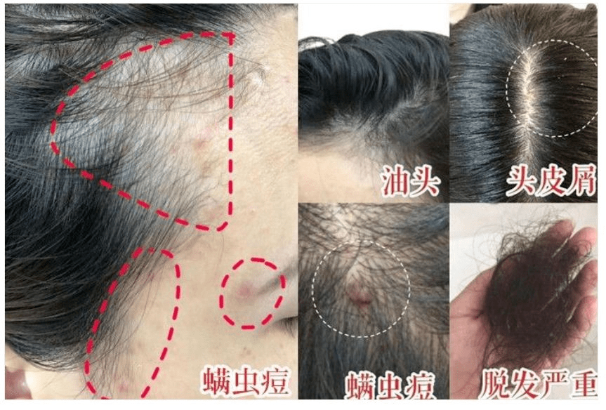 最新驱螨技术，开启无螨生活新篇章